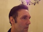 9hrs Post Op Right Side 16-05-16.JPG