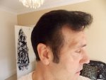 2 Days Post Op Right Side close up 18-05-16.JPG