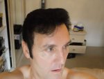 9 Days Post Op Right Side 25-05-26.JPG