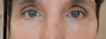 9 Days Post Op Around eyes  25-05-16.JPG