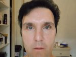 9 Days Post OP Front 25-05-16.JPG