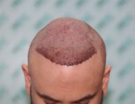 thumbnail_4. post op Front.jpg
