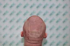 thumbnail_5. Post op Top back.jpg