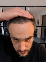 9. one year after Hairline.jpg
