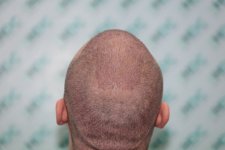 thumbnail_6. five days after Top Back.jpg
