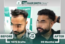 best hair transplant clinic in india - after 9 months result - the hairsmith clinic.jpg