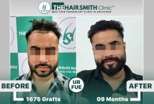 best hair transplant results in india - the hairsmith clinic.jpg