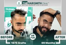 best hair transplant result - the hairsmith clinic.jpg