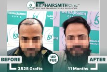 11 months hairsmith hair transplant result - the hairsmith clinic delhi - 2.jpg