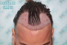 5 FUE1 on 16-03-25 for 2800 Grafts.JPG