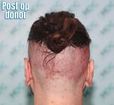 6 Back donor post op.JPG