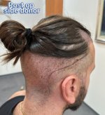 7 Donor postop.JPG