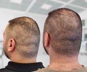 donorgebied herstel micro haar pigmentatie voorbeeld.jpg