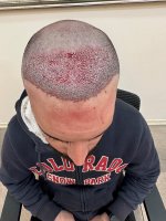 4. Post op 3460 grafts top.jpg