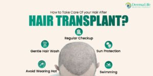 How-to-Take-Care-of-Your-Hair-After-a-Hair-Transplant-300x150.jpeg