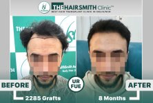 the hairsmith clinic hair transplant result #hairtransplant #hairsmithhairtransplant.jpg