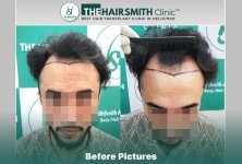 Before Hair Transplant HS 844- The Hairsmith Clinic Delhi India - #hairtransplant.JPG