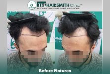 Before Hair Transplant HS 844- The Hairsmith Clinic Delhi India - #hairtransplant #hairregrowth.JPG