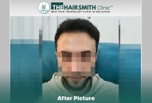 8 months hairsmith hair transplant result - the hairsmith clinic delhi #hairtransplant.JPG