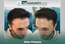 8 months hairsmith hair transplant result - the hairsmith clinic delhi #hairtransplant #thehai...JPG