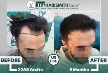 the hairsmith clinic hair transplant result #hairtransplant #hairsmithhairtransplantcost.jpg