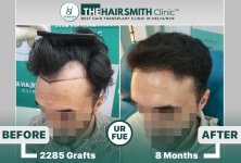 the hairsmith clinic hair transplant result #hairtransplant #hairsmithhairtransplant #hairregr...jpg