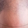 Hair Restoration