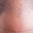 Hair Restoration