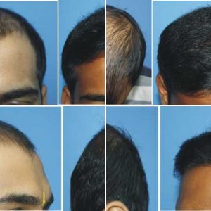 Rrejuvenate Hair- 5100 Grafts FUE Result