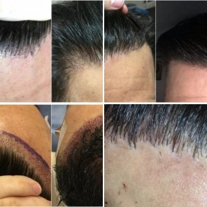 Kierach Hair Transplant
