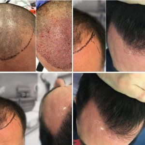 Hair Restoration Europe
