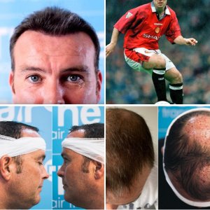 Ben Thornely FUE Hair Transplant