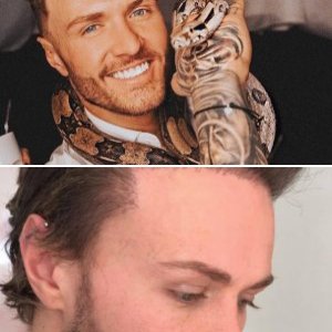 Kyle Christie Hair Transplant