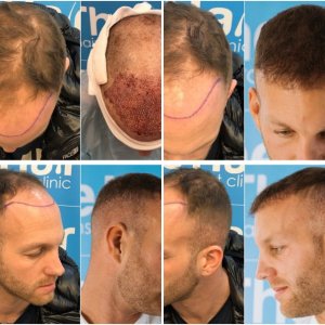 3500 FUE Dr Arshad Hair Dr