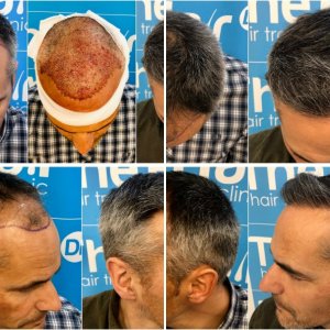 2148 FUE Hair Dr UK