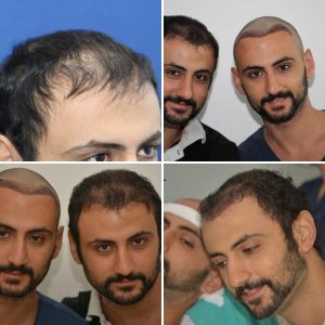 Identical twin hair transplant