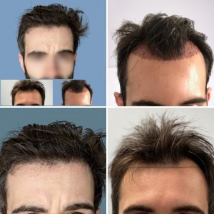 Hairline 1700 grafts Dr Nikos Hair Transplant NZK Medical