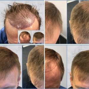 2000 grafts NZK Medical - Dr Nikos Hair Transplant