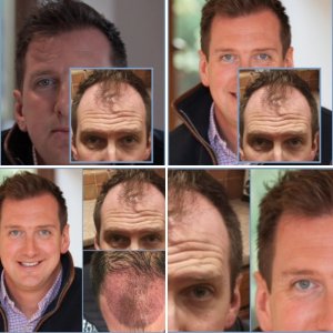 Dr Nikos hair transplant result, hairline to mid-scalp