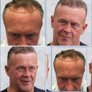 Dr Nikos hair transplant result, hairline and frontal