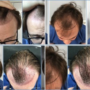 NZK Medical - Dr Nikos Hair Transplant
