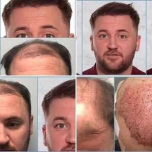 Dr Nikos hair transplant result, hairline to mid-scalp