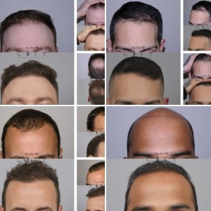Hair Transplants