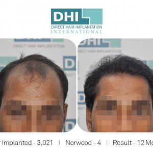 DHI Success Story   - Hair Transplant Before and After Results.