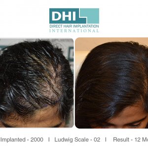 27 Year Old Female Hair Transplant Life Changing Journey