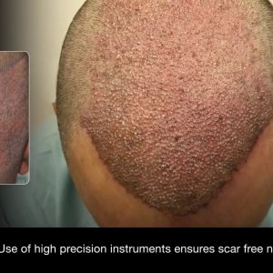 DHI vs FUE : Difference between DHI Technique and FUE.