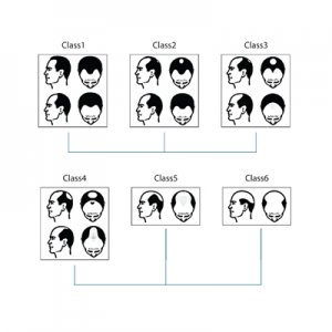 How Can One Decide What Amount Of Hair Is Required to Cover The Scalp?