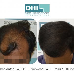 Hair Transplant Amazing Results