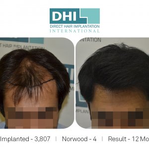 DHI Success Story   - Hair Transplant Before and After Results.