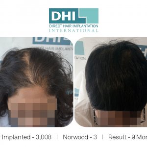 Female Hair Transplant Results - DHI